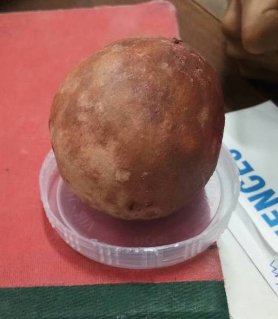 मूत्राशय से निकाली 6.4 सेंन्टीमीटर की पथरी मूत्राशय से निकाली 6.4 सेंन्टीमीटर की पथरी
