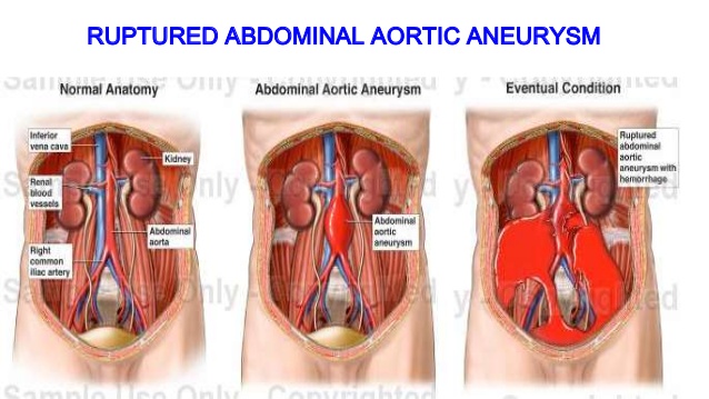 “Ruptured Abdominal Aortic Aneurysm Treated Successfully First in Rajasthan”