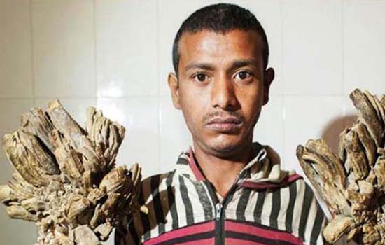 एक बार फिर चर्चा में है बांग्लादेश का 28 वर्षीय ट्री मैन