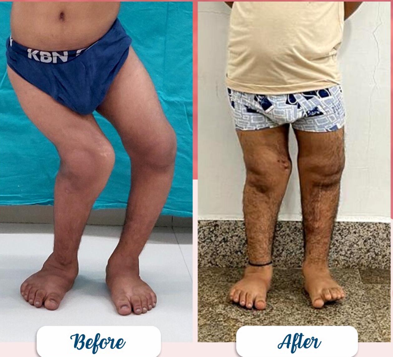 Successful Treatment of Skeletal Dysplasia, a Rare Medical Condition