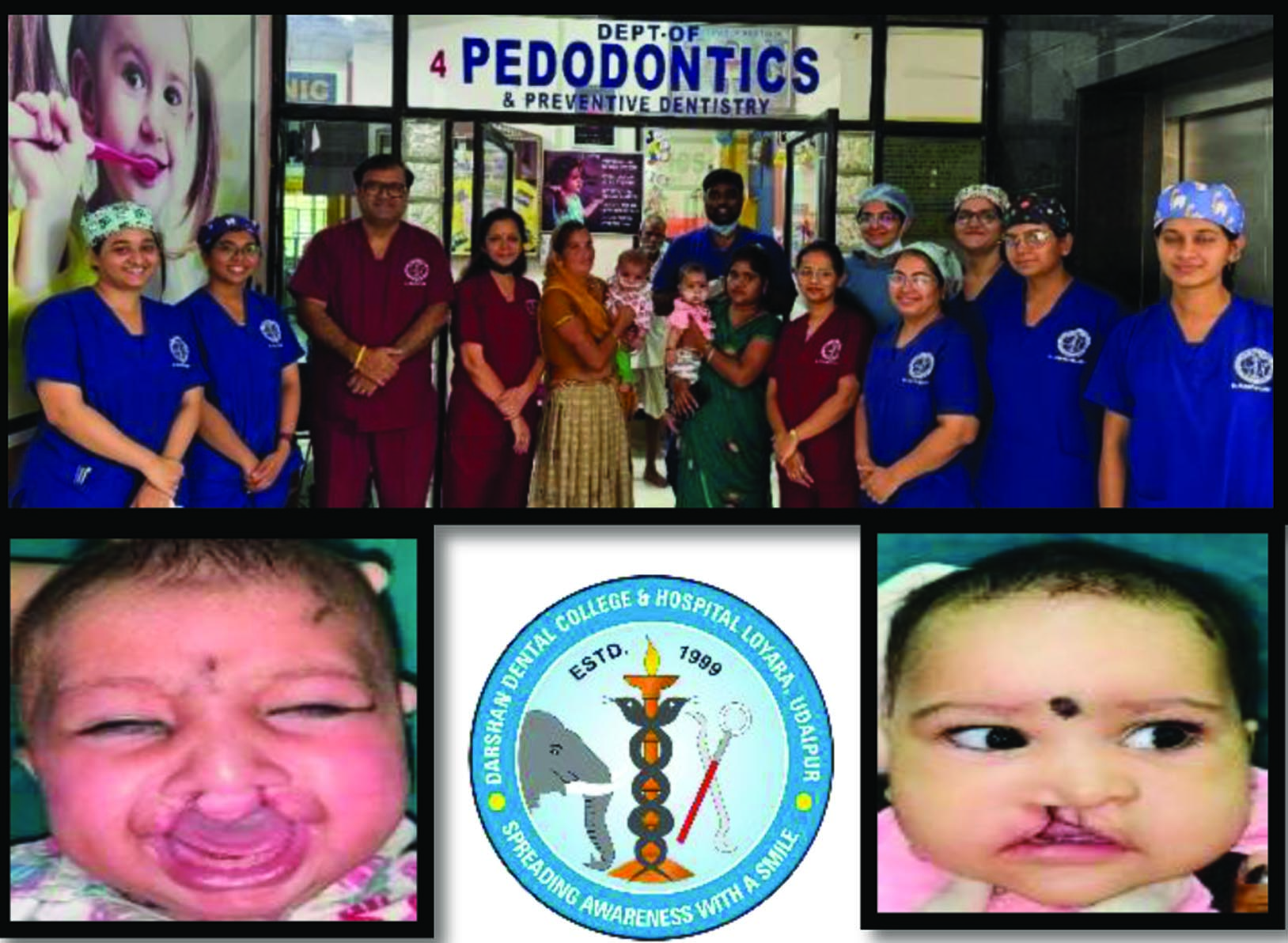 Hope for Children with Cleft Lip and Palate through Successful NAM Therapy at Darshan Dental College